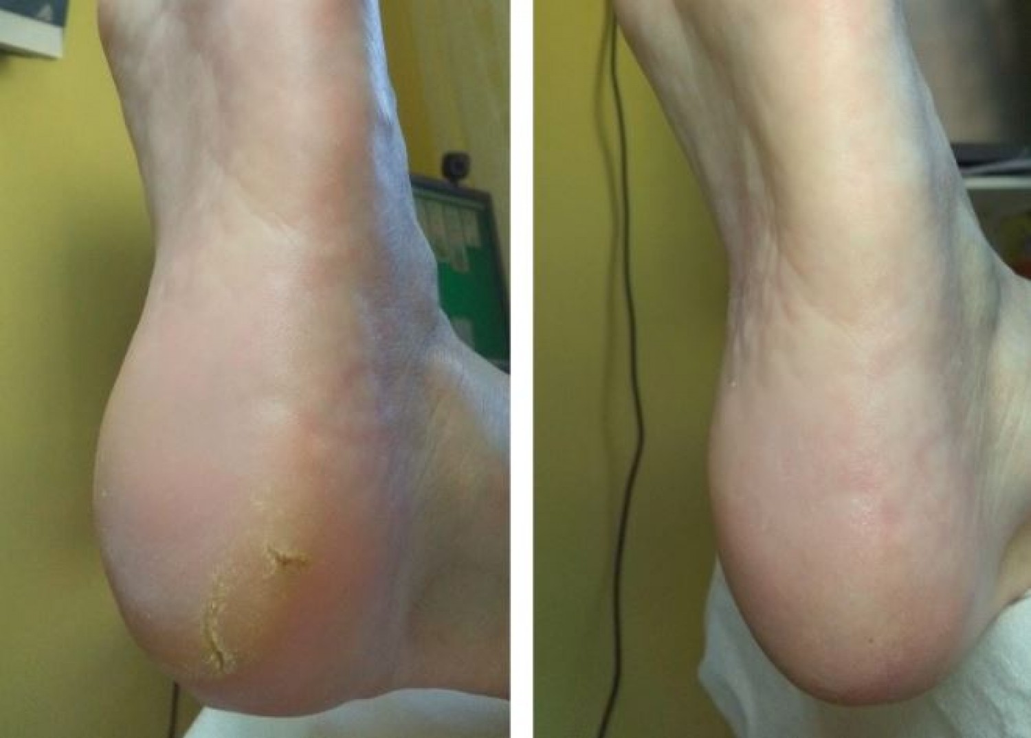 A nagymamától tanultam ezt a trükköt: a száraz sarkak ellen a legjobb