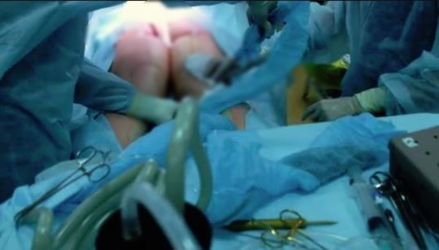 Belehalt a fenékplasztikai műtétbe egy kétgyermekes brit anyuka Budapesten