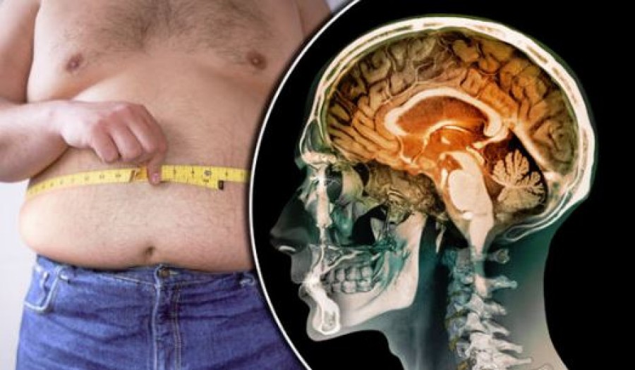 Kisebb lehet az agyuk az elhízott embereknek