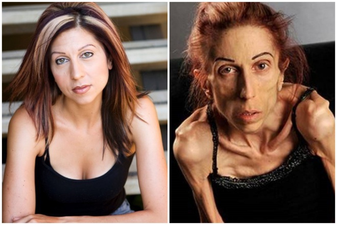 A 37 éves színésznő már alig 20 kilót nyomott! Képtelen volt kigyógyulni az anorexiából.