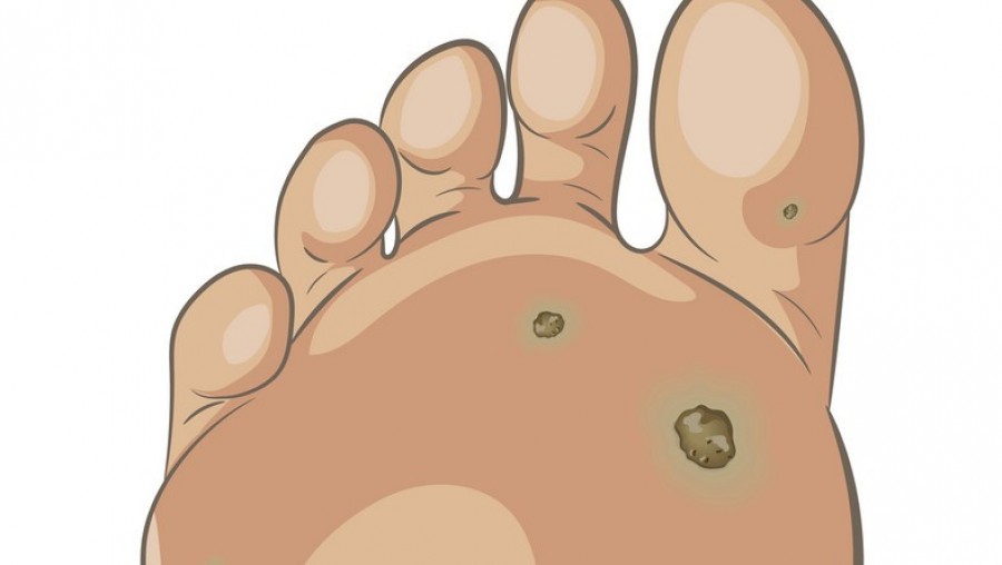 Bőrkeményedés vagy tyúkszem: így szabadulhatsz meg tőle mindörökre egy egyszerű házi módszerrel