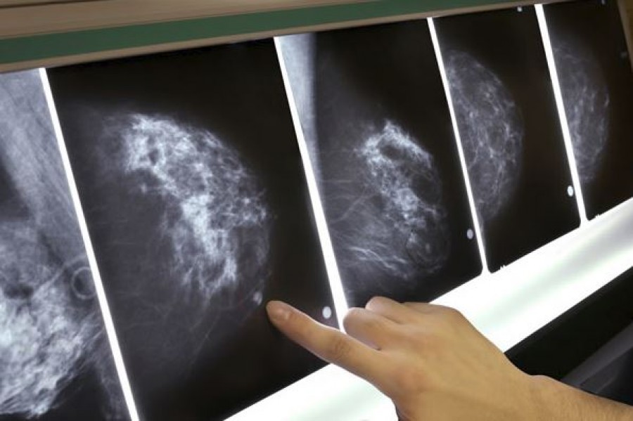 Egy orvos meglepő őszinteséggel beszélt a mammográfiáról. Minden nőnek el kellene olvasni.
