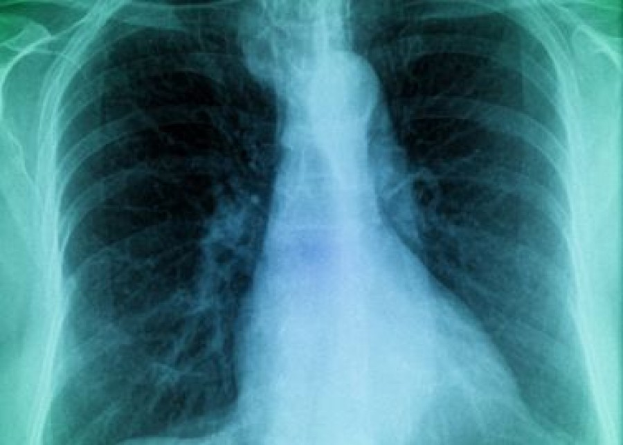 Új tüdőbetegség nevét kell megtanulnunk, ami kegyetlenebb a tüdőráknál