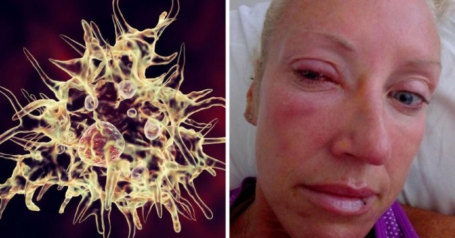 Ez a nő szinte elvesztette látását, mert egy vírus befészkelte magát a kontaktlencséjébe!